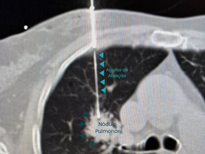 Guia Prático das Principais Dúvidas Sobre Ablação Guiada por Imagem