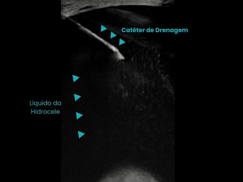 Saiba Tudo Sobre os Benefícios da Esclerose de Hidrocele Guiada por Imagem