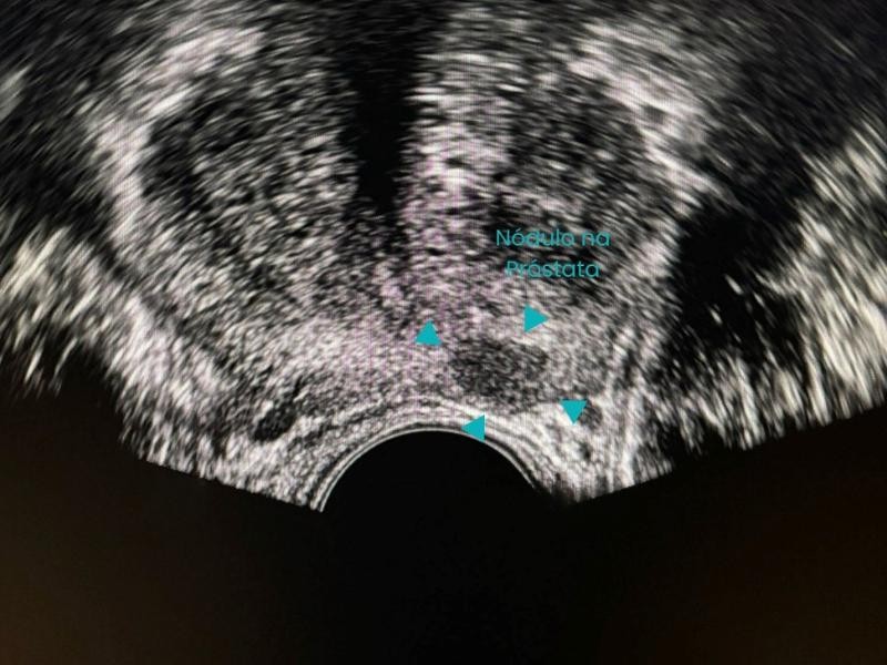 Guia Definitivo Sobre Ablação de Próstata Guiada por Imagem