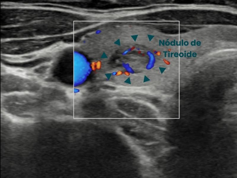 Saiba Como Funciona Ablação de Tireoide