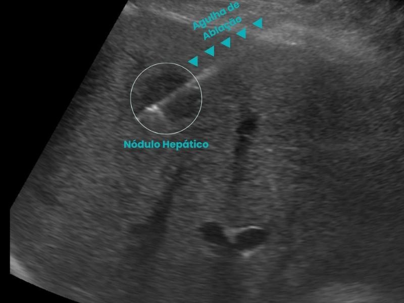 Guia Definitivo Sobre Ablação Hepática Guiada por Imagem