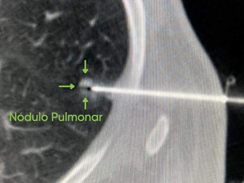 Guia Definitivo sobre Ablação Pulmonar: Tudo O Que Você Precisa Saber Sobre Ablação Pulmonar