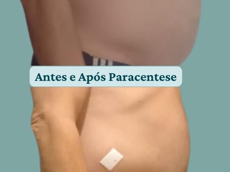 Saiba Quando a Paracentese é Indicada